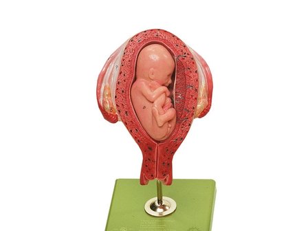 Baarmoeder met foetus, maand 5, stuitligging